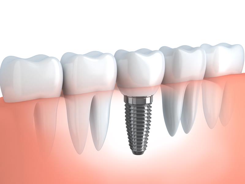 Dental Implants  Dublin, CA