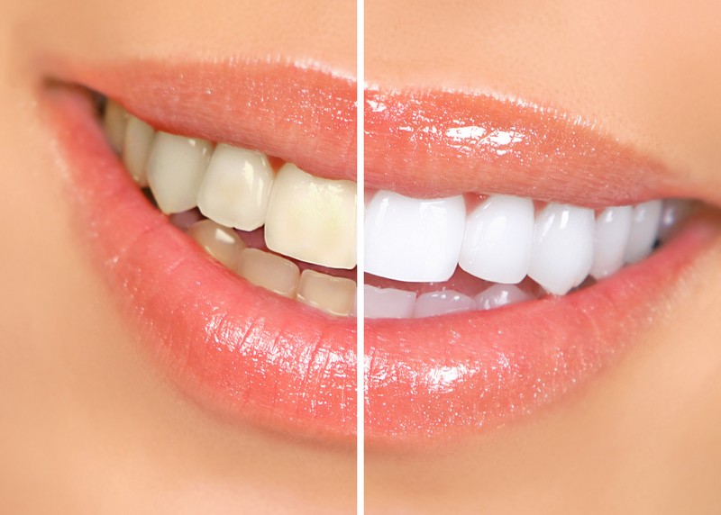 Teeth Whitening  Dublin, CA